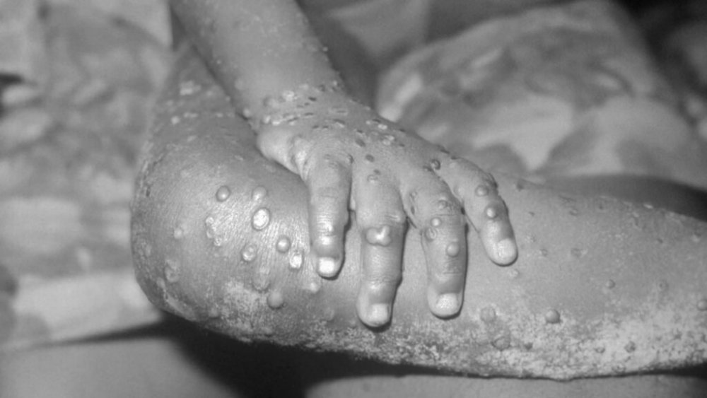 Belgium-becomes-first-country-to-introduce-mandatory-monkeypox-quarantine-as-1024x576.jpeg